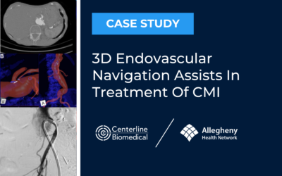 3D Endovascular Navigation Assists In Treatment Of CMI