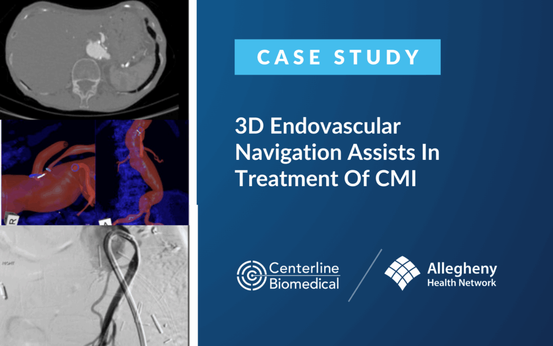 3D Endovascular Navigation Assists In Treatment Of CMI