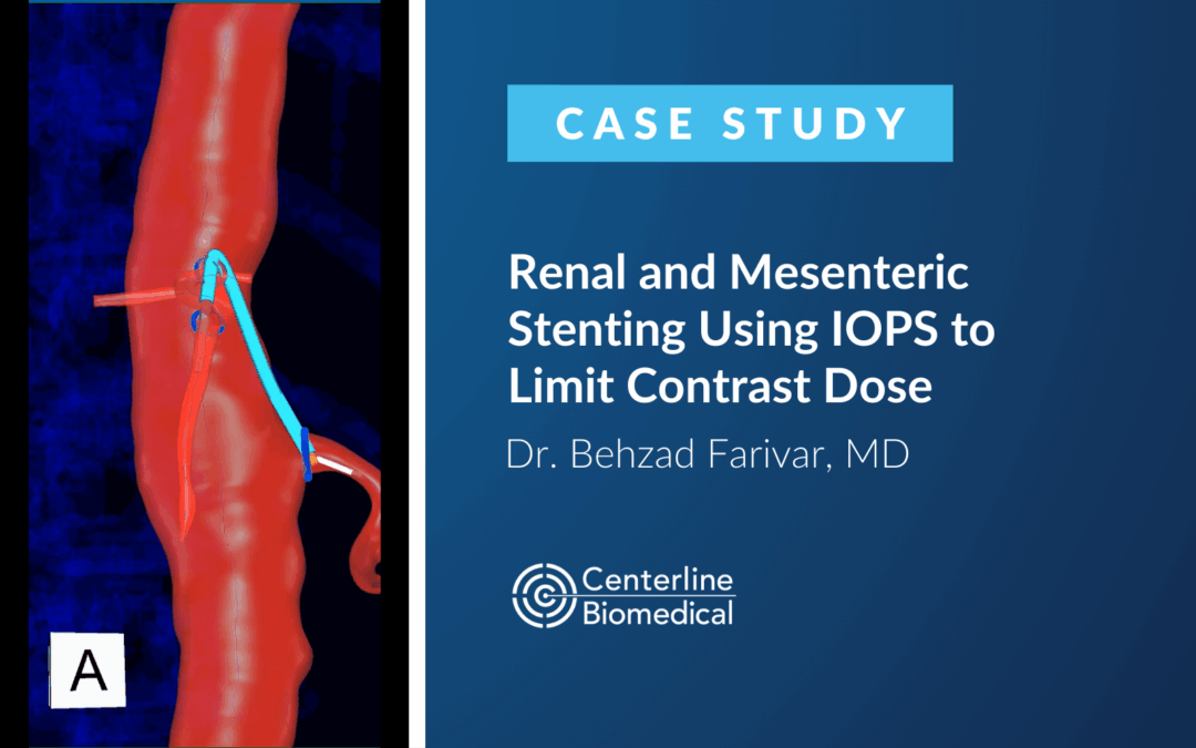 Renal and Mesenteric Stenting Using IOPS to Limit Contrast Dose