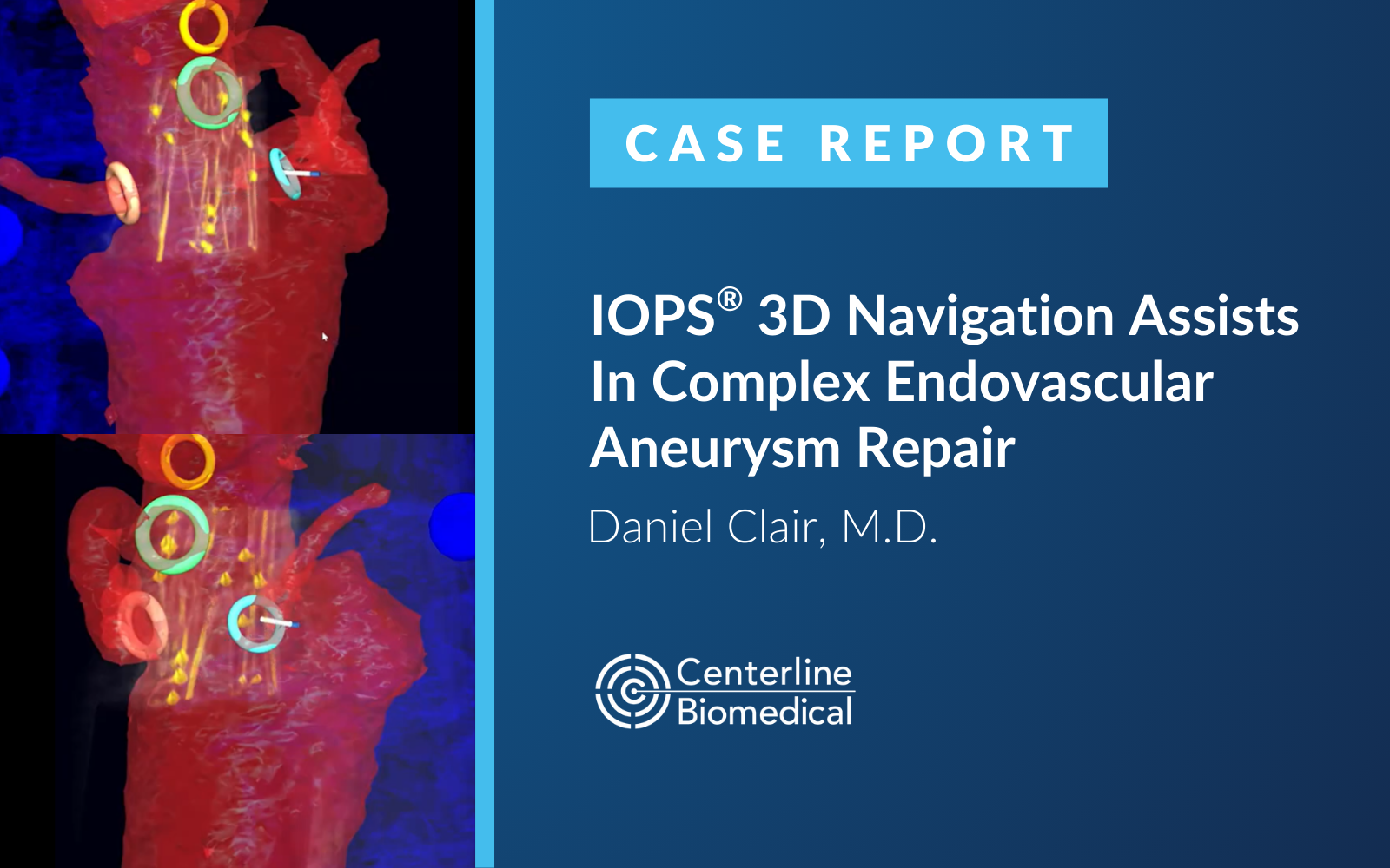 IOPS 3D Navigation Assists In Complex Endovascular Aneurysm Repair